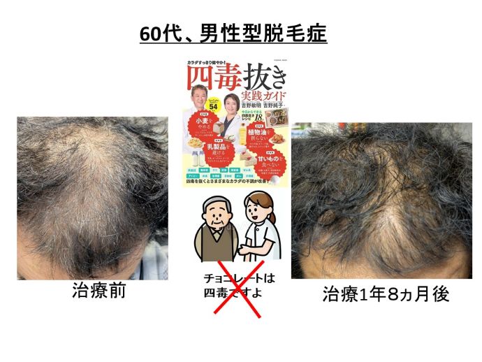 円形脱毛症　病院
